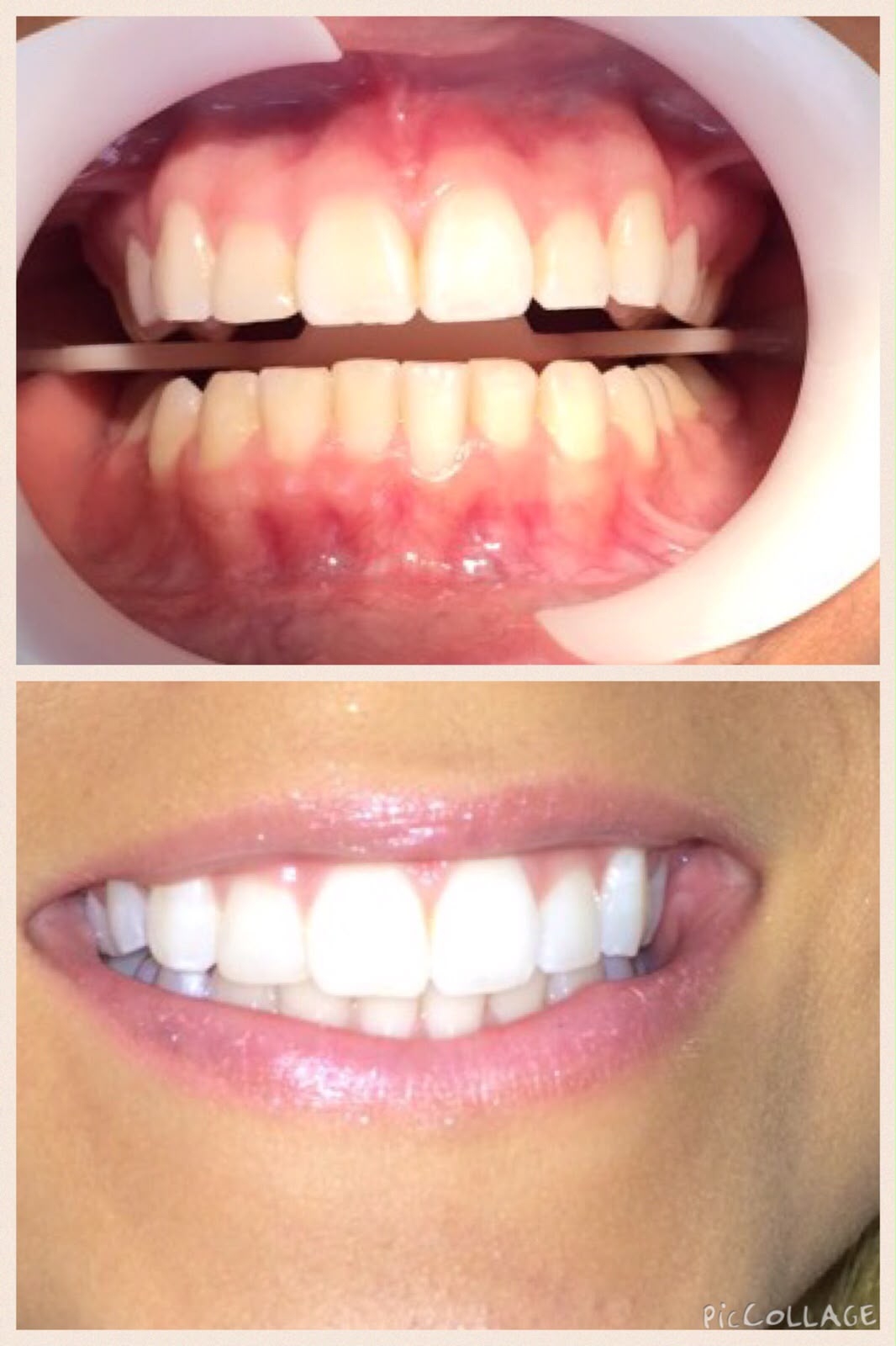 Antes e depois do clareamento, foto 2
